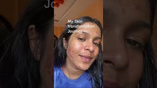 Skin Transformation #skincare #youtubeshorts #glowup #acne #trending #acnepositivity #fyp