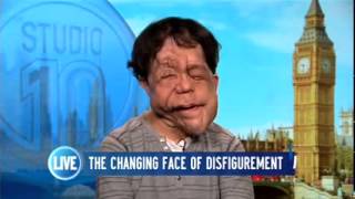 adam pearson talk under the skin and scarlett johansson on studio 10
