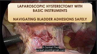 Total Lap Hysterectomy | Previous LSCS | Basic Instruments | Dr Sanket Pisat