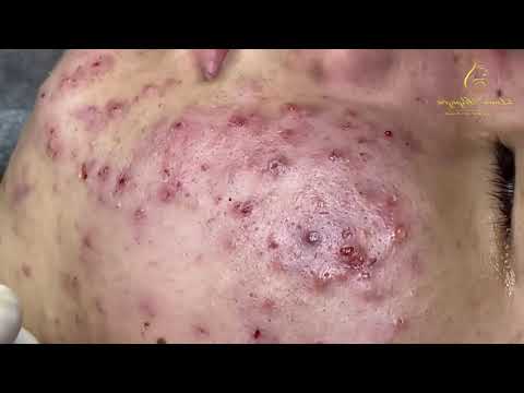 blackheads remoaval 1611