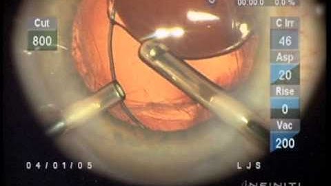 Managing a subluxated Sulcus IOL