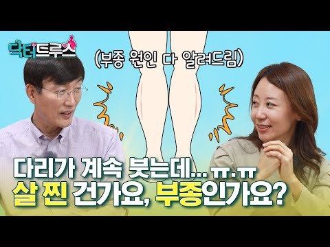 다리 부종, 살찐 건지 부종인지? 다리 붓는 원인 [닥터트루스] 슬기로운 심장생활 29