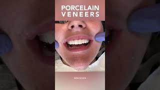 Porcelain Veneers #Shorts