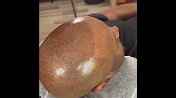 Scalp Micropigmentation 1st session results. Dallas Texas .