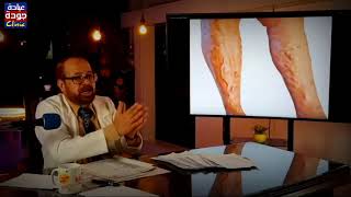أسرع علاج لدوالى الساقين ببساطة بدون جراحة / دكتور جودة محمد عواد