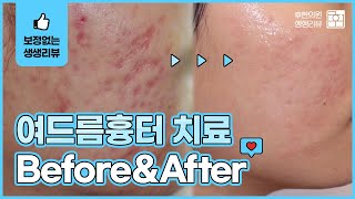 여드름흉터 치료 한방시술 전후사진 살펴봐요_후한의원
