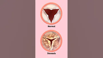 Heart valve stenosis #heart #heartvalves #stenosis #cardiology #shorts