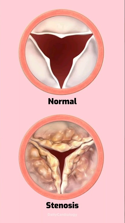 Download lagu Heart valve stenosis #heart #heartvalves #stenosis #cardiology #shorts