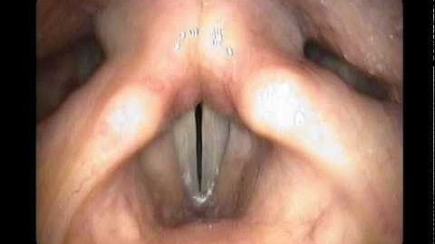 Upper Airway Anatomy During Trans-Nasal Endoscopy (HD)