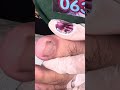 Ep_6596 Ingrown toenail removal 👣 น้องร้องเจ็บได้น่ารักมาก 😄 (clip from Thailand)