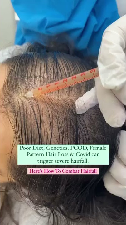 {2024 } PRP - Best hair loss treatment for females #shorts