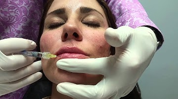 Restylane Lyft Cheek, Silk Lip Enhancement Weiner