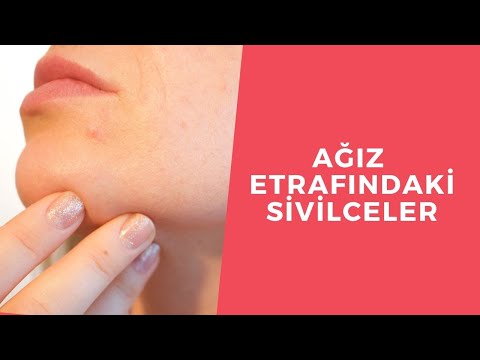 Video: Perioral Dermatit Nasıl Tedavi Edilir: 8 Adım (Resimlerle)