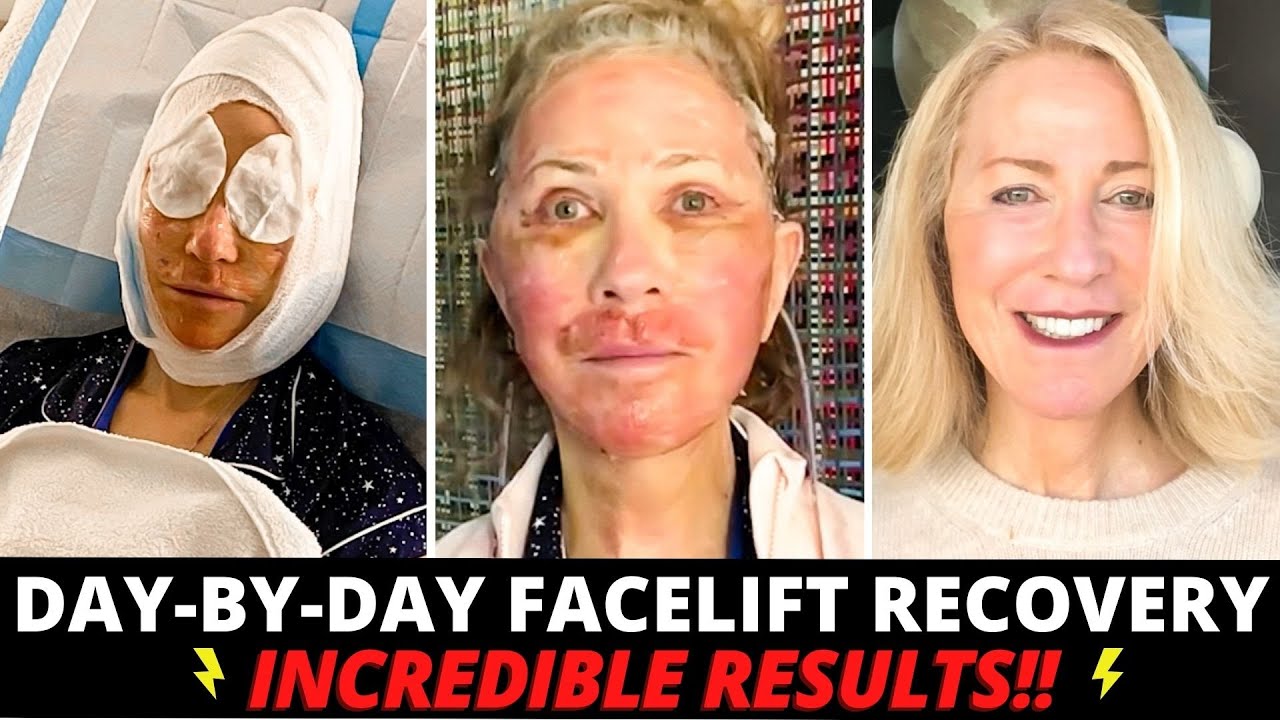 68 Year Old Undergoes Incredible Facial Plastic Surgery Transformation (Day by Day Healing Process)