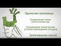 Недостаточность аортального клапана (операция Давида)