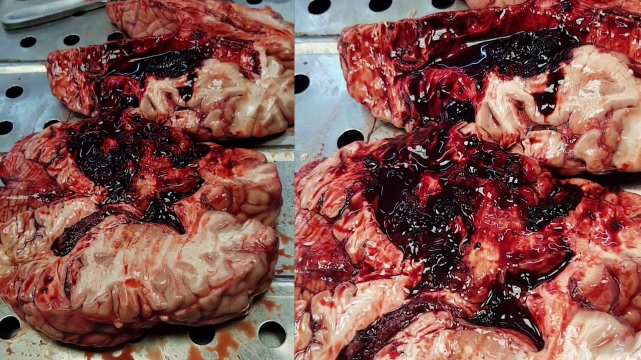 Инсульт геморрагический