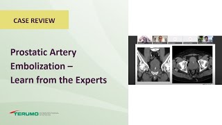 Prostatic Artery Embolization - Learn from the Experts | Terumo Interventional Systems