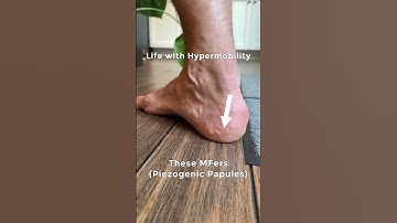 Life with hypermobility and Ehlers Danlos related symptoms #flexibility