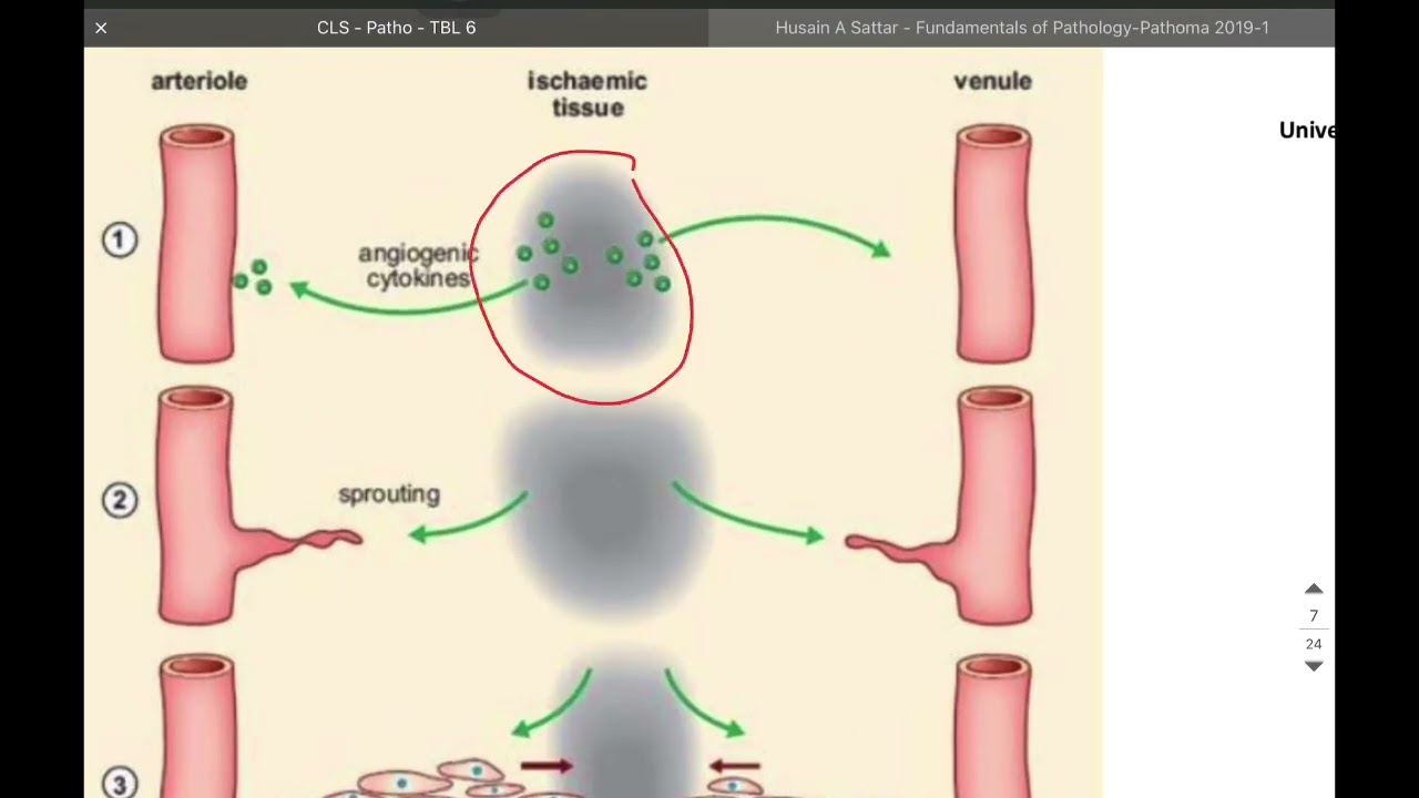 CLS - Pathology - Lecture 6 - Tissue repair- part 2