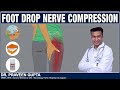 Foot drop nerve compression  dr praveen gupta