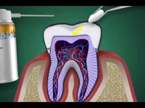 was ist eine Zahnnerventzündung - Pulpitis