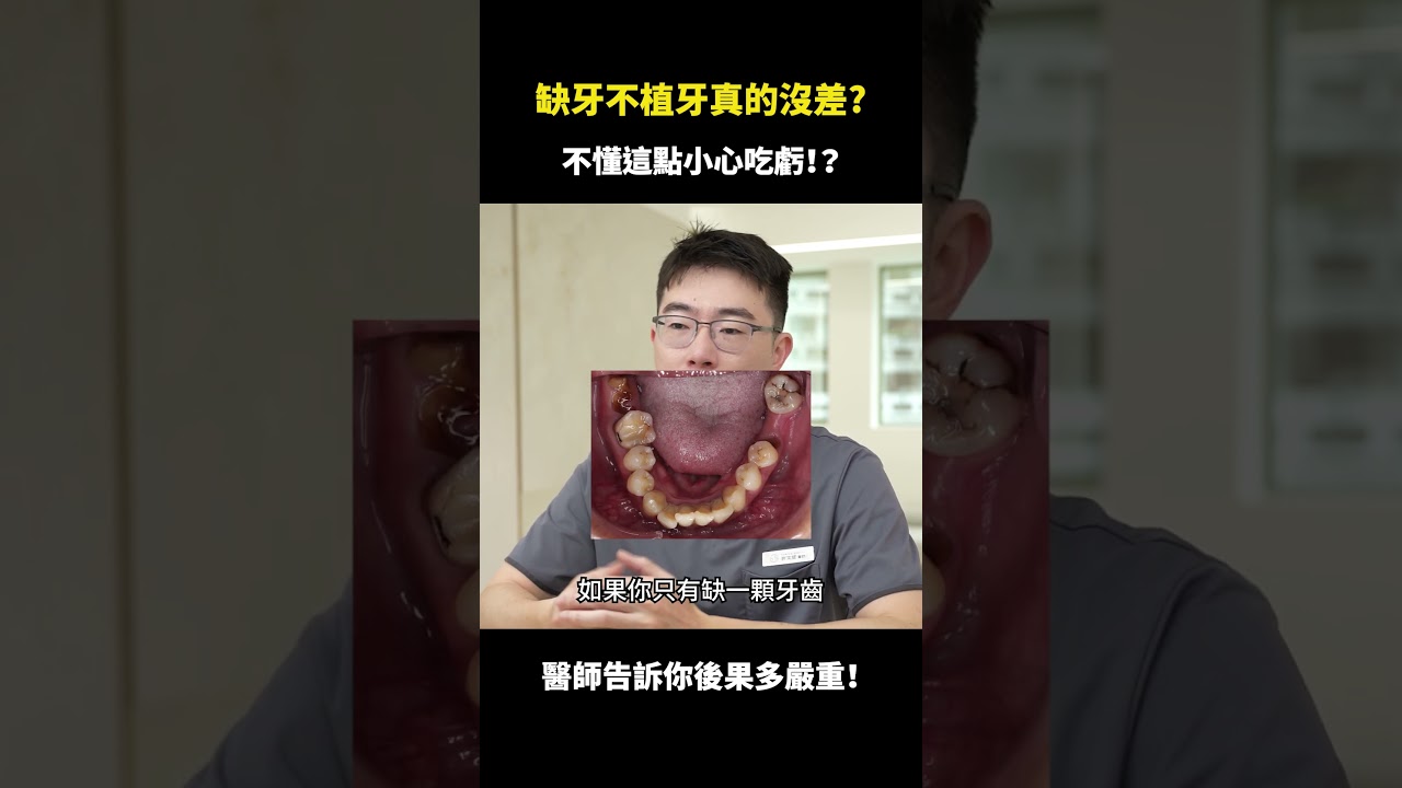 缺牙不植牙真的沒差？不懂這點小心吃虧！｜【祐民牙醫－隱適美旗艦店】許文斌醫師 (大許醫師) #缺牙 #植牙 #祐民牙醫