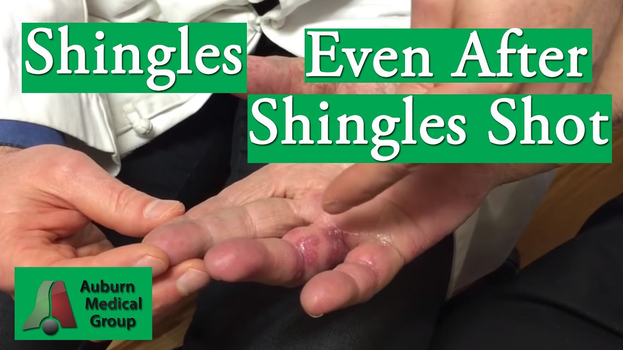 Shingles on the Hand Even After Shingles Shot Auburn Medical Group