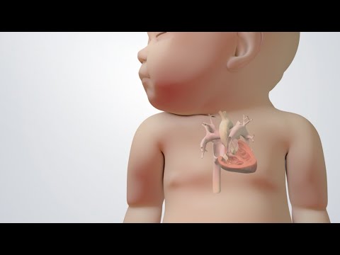 Blue Baby Heart Defect: Tetralogy of Fallot Treatments