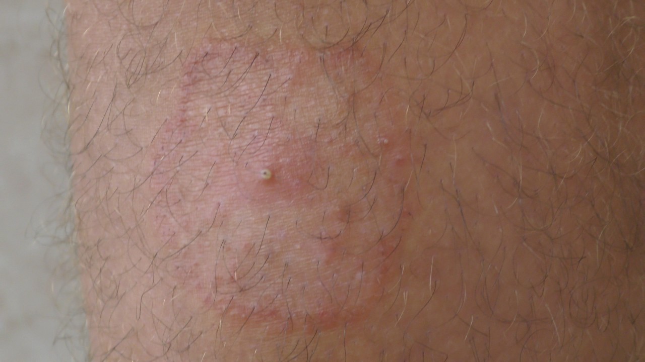 A Dermatophyte ( fungal) infection on a yachtsman's calf - YouTube