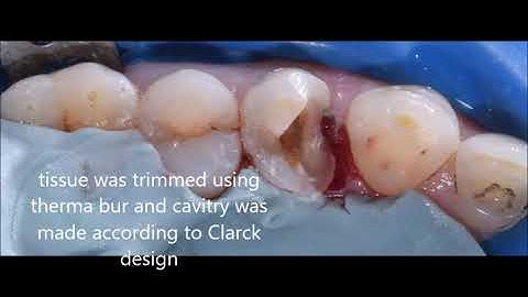 Injection molding with bioclear