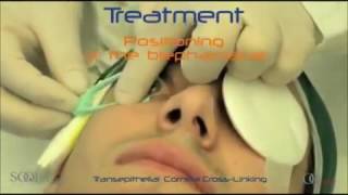 Cross-linking rogówki - Epi-On