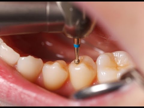 როგორ ხდება კბილის დაბჟენა ?