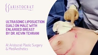Ultrasonic Liposuction (UAL) on Male with Enlarged Breast by Dr. Kevin Tehrani