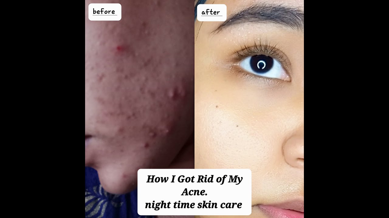 How I Got Rid Of My Acne In Just Three Months| Home Pimple Treatment ...