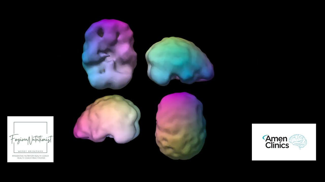 My Easy SPECT Scan Experience At The Amen Clinic - YouTube