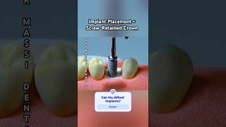 Screw-Retained Implants Explained: Step-by-Step#implant #dentist #vibes