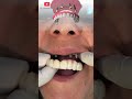 Increible transformación! ❤  implantes dentales