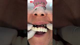 Increible transformación ❤  implantes dentales