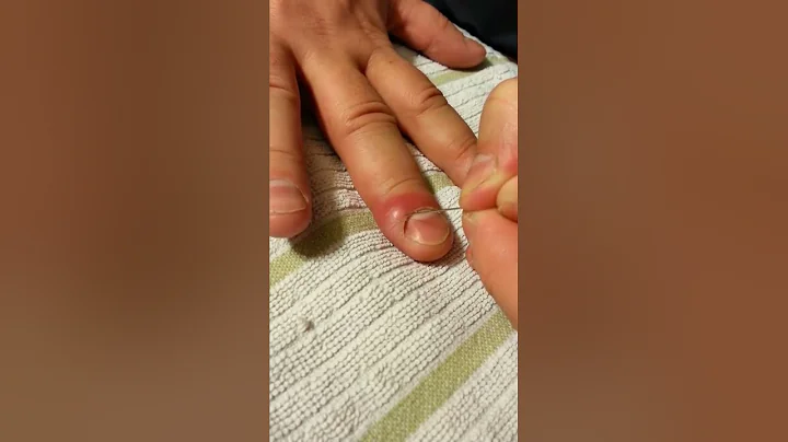 Lance or drain ingrown nail or infected cuticle