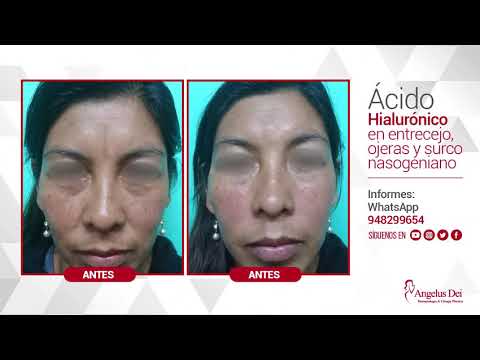 Antes y Después - Ácido Hialurónico
