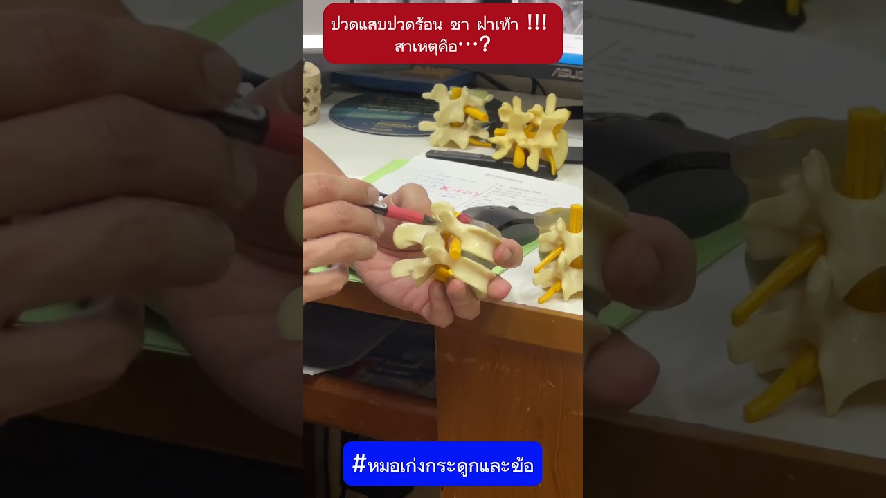 ปวดแสบปวดร้อน ชา ฝ่าเท้า สาเหตุคือ Part 1 #หมอเก่งกระดูกและข้อ #ปวด #ชาฝ่าเท้า
