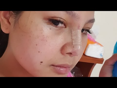 my nose surgery story💉💊|ประสบการณ์ทำจมูก อักเสบ