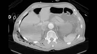 Chest CT scan of a chest following rib fractures