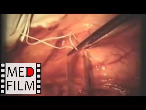 Хирургия язвенной болезни 12-перстной кишки © Surgery of peptic ulcer disease 12 duodenal ulcer