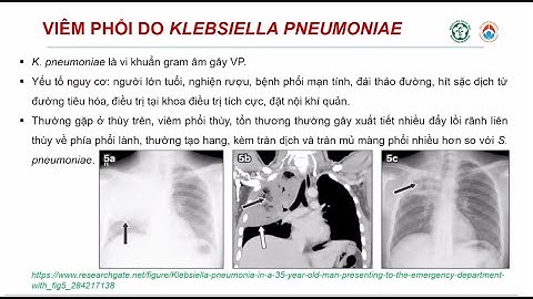 Cập nhật chẩn đoán và điều trị viêm phổi cộng đồng