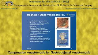 Compression Anastomosis for Gastro-Jejunal Anastomosis