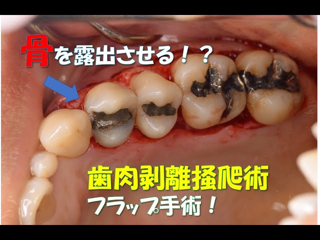 閲覧注意】フラップ手術 歯周外科 スケーリング 歯石取り ダイジェスト