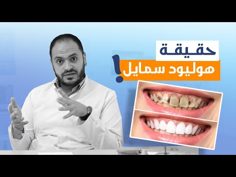 أهم معلومات عن هوليود سمايل ابتسامة هوليود د أحمد العايدي