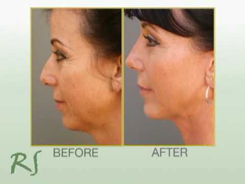 http://www.spaldingplasticsurgery.com Spalding Chin augmentation: Chin augmentation can alter the underlying structure of the face, providing better balance ...