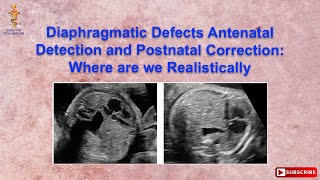 Diaphragmatic Defects Antenatal Detection and Postnatal Correction: Where are we Realisticall